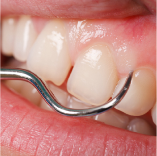 歯周組織(歯ぐき・骨)の状態